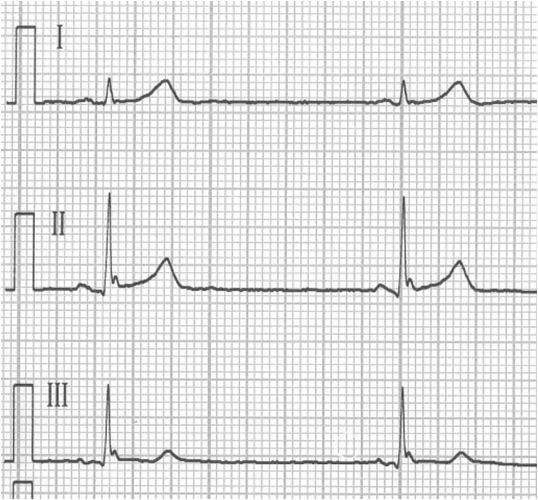 the-12-lead-ecg-shows-an-early-repolarization-pattern